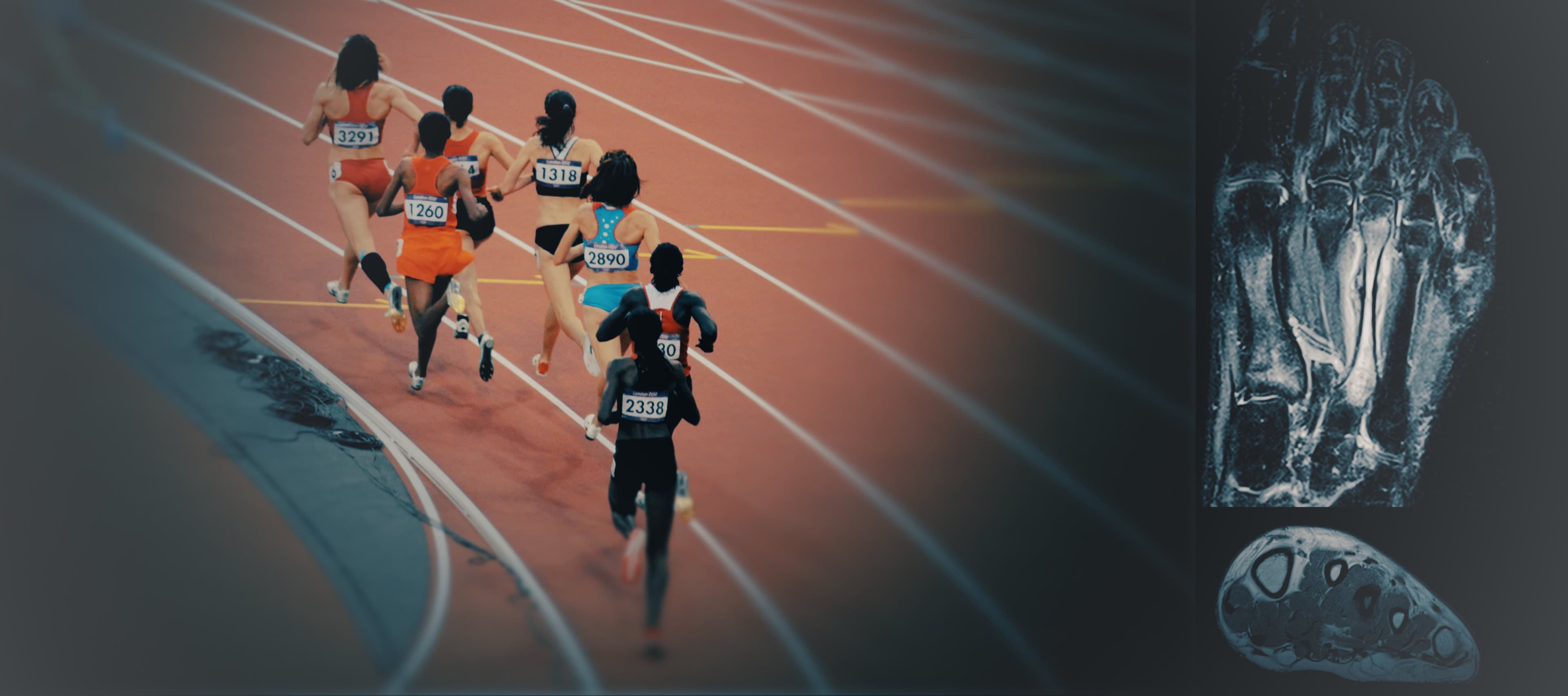 Radiology, Running, MRI, Stress injury, X-Ray