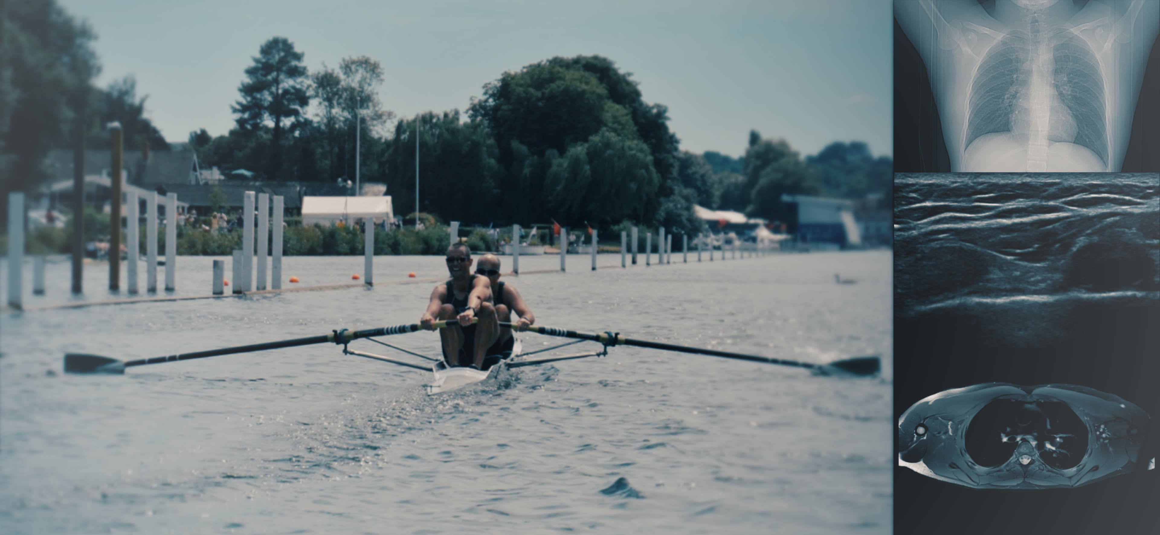 Radiology, Rowing, Chest injury, MRI, X-Ray